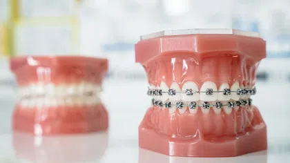 Dental models showing teeth with metal braces and without, used for orthodontic demonstration.