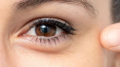 Crows Feet