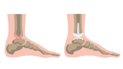 Illustration showing ankle joint replacement with damaged joint and prosthetic implant in the foot bones.
