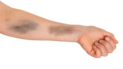 a bruised arm