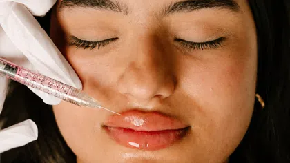 Close-up of a woman receiving a lip filler injection with a syringe by a gloved hand.