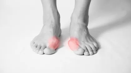 Feet with highlighted red areas on big toe joints indicating bunion pain or inflammation.