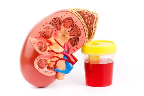 Hematuria (Blood in the Urine) 