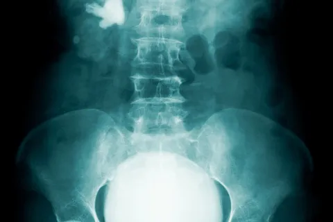 What Is Urodynamic Testing?