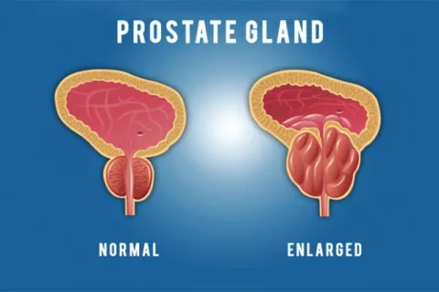 Elevated Prostate Specific Antigen (PSA) 