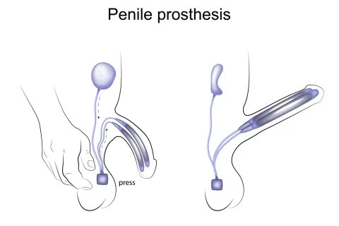 How Does a Penile Implant Work? 