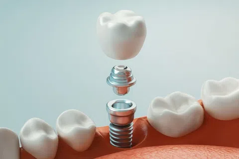 3D illustration of a dental implant being placed between natural teeth in the jawbone.
