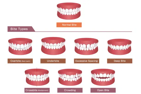 Diagram showing seven types of dental bites including normal, overbite, underbite, spacing, deep bite, crossbite, crowding, and open bite.