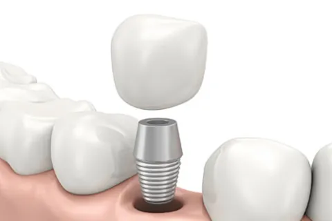 Dental Implants Strengthen Smiles (video)