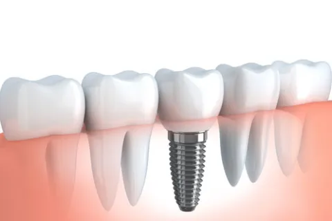 Give Yourself New Teeth With Implants