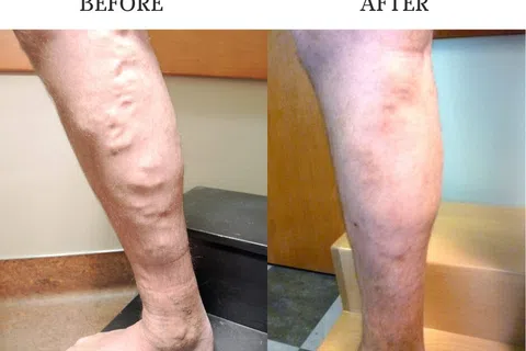 Best Treatment for Varicose Veins in Atlanta, GA: A Complete Guide