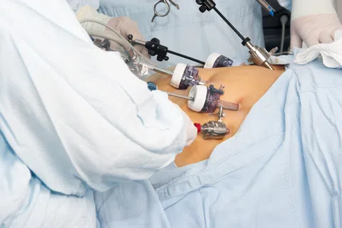 Gastric Bypass Surgery