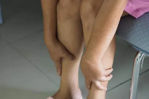 How to Relieve Painful Varicose Veins: Real Answers That Actually Help