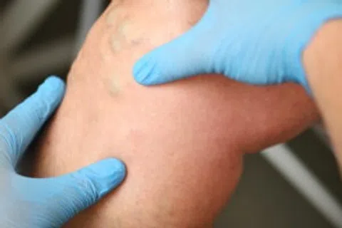 Signs and Symptoms of Venous Insufficiency: What Your Legs Are Trying to Tell You