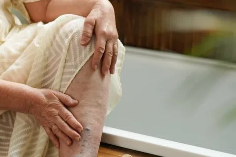 Spider vs Varicose Veins: What’s the Difference and When to Worry