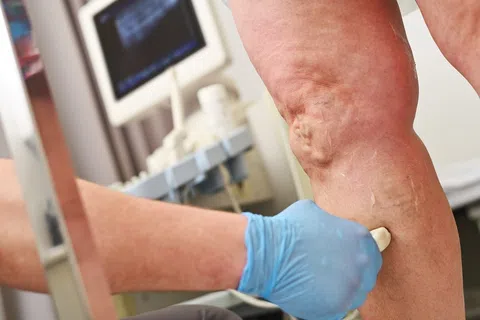 Vein Disease Is Everywhere in the News: But Here’s What Actually Matters for You