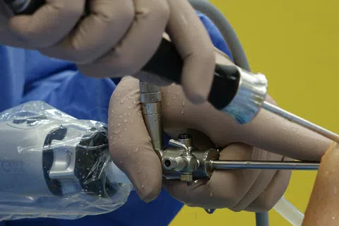 What Sleeve Gastrectomy Patients Need to Know About Barrett’s Esophagus