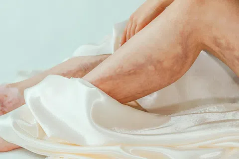 Varicose Veins: What Are They — And What Happens If You Don’t Treat Them?