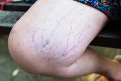 What is the most successful treatment for varicose veins?