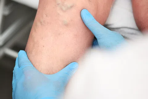 What Is The Best Treatment For Spider Veins?