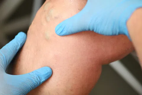 What is Venous Insufficiency, and How is It Linked to Obesity?