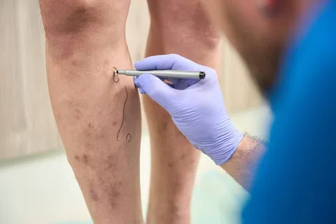 What are the early stages of venous insufficiency?