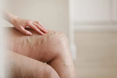 VenaSeal™ Treatment for Varicose Veins: Your Solution for Lasting Relief in Atlanta, Stockbridge, and Newnan, GA