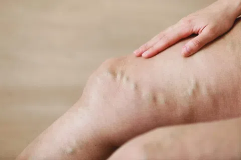 What Triggers Venous Insufficiency? Exploring the Root Causes of This Circulatory Disorder