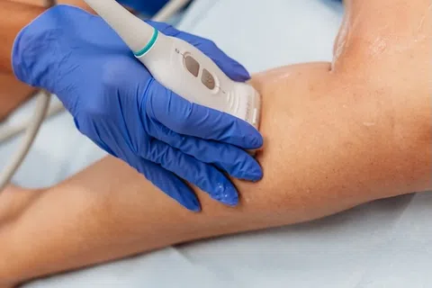 Spider Veins vs. Varicose Veins: What’s the Difference — and When Is It More Than Just Cosmetic?