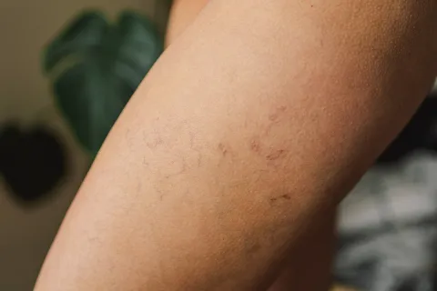 Is Asclera Right for You? A Clear Guide to Spider Vein Treatment