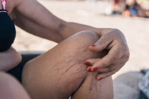 From Boots to Bare Legs: Why Winter is the Time to Fix Spider Veins