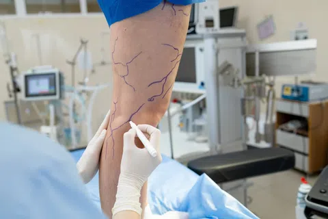 Do You Need a Vein Screening? Signs You Shouldn’t Ignore