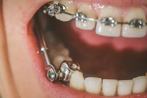Close-up of teeth with braces and orthodontic headgear inside an open mouth.