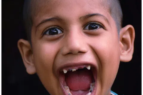Close-up of a joyful boy with a shaved head wearing a blue shirt and wide open mouth showing teeth.