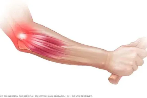 Everything You Need to Know About Tennis Elbow (Even if you Don't Play Tennis)