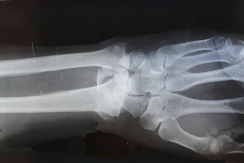 X-ray image showing the bones of a human wrist and forearm with clear bone structure and joints.