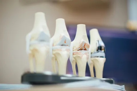 Four anatomical knee joint models showing progression of joint damage and replacement prosthesis on a blurred background