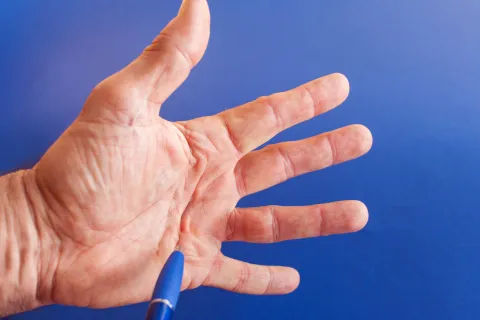 a close-up of a hand - Dupuytren's Contracture - OrthoSouth Memphis Hand Center