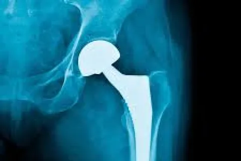 X-ray image showing a hip joint with a metal prosthetic implant replacing the femoral head and neck.