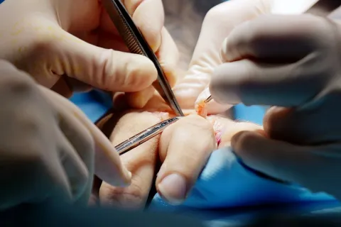 Close-up of surgeons performing delicate hand surgery with precision instruments and gloves.