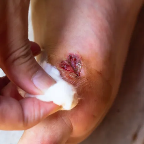 Hand cleaning an infected wound on the foot with cotton, showing red inflamed skin and injury details.