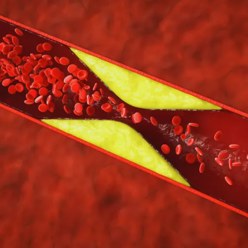 Cross-section of a narrowed artery showing yellow plaque buildup and red blood cells flowing through a constricted vessel.