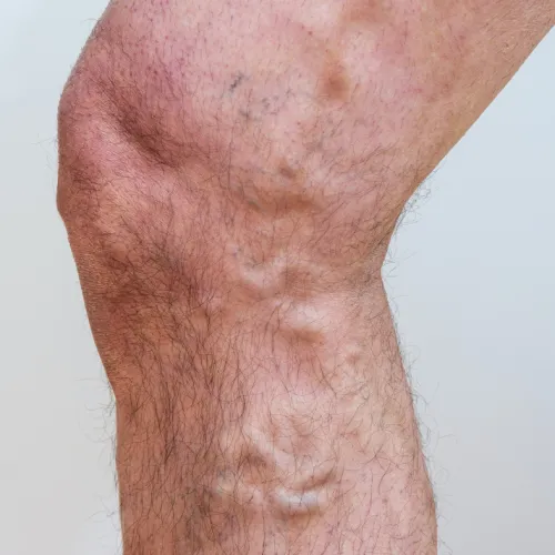 Close-up of a hairy leg showing visible varicose veins on the skin against a plain background