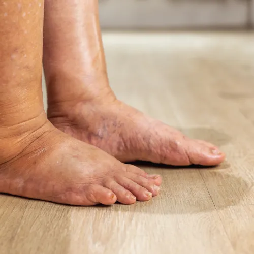 Close-up of swollen feet and ankles with visible veins standing on wooden floor indoors.