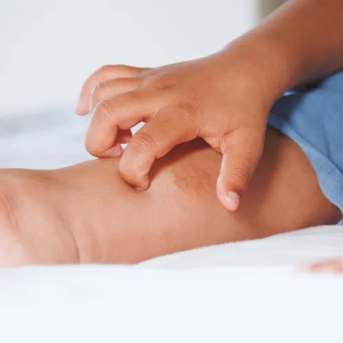 Child scratching leg with visible skin irritation or rash on lower leg while sitting on bed.