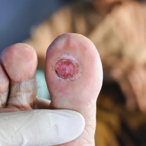 Close-up of a foot with a circular wound or ulcer on the big toe, held by a gloved hand.