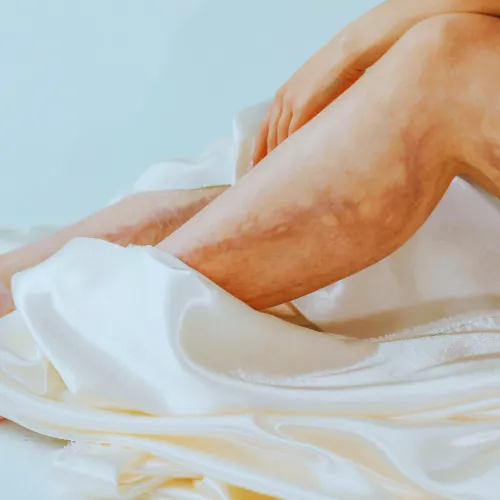 Close-up of legs with skin discoloration resting on smooth white satin fabric background.