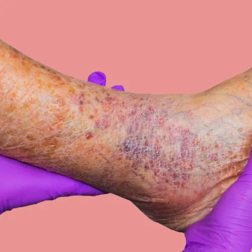 Close-up of a leg with bruises and dry skin held by hands wearing purple gloves against a pink background