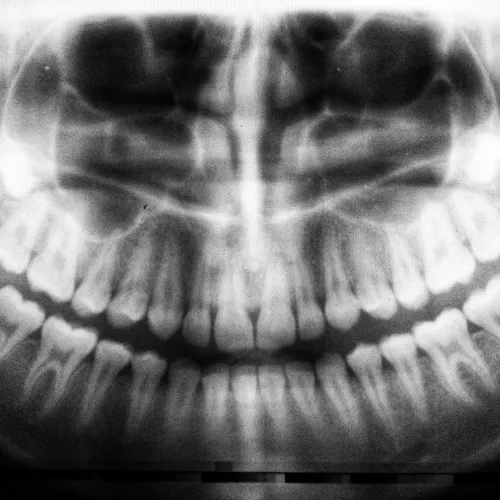 Black and white panoramic dental X-ray showing full adult teeth and jaw structure