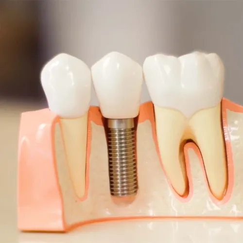 a group of teeth and implant